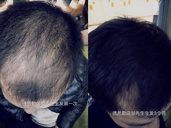 星尚源客户生发效果
