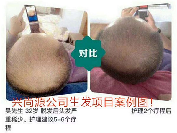 兴尚源生发效果