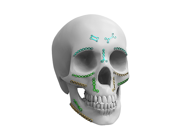 顱頜面釘板固定系統