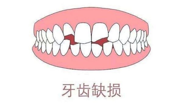 牙齿缺损的危害