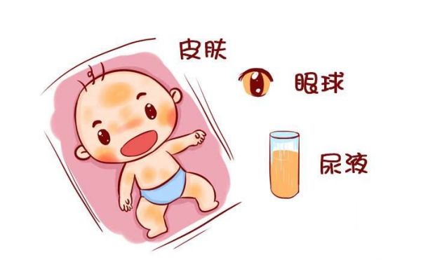 来长沙学习正规的月嫂，告诉您什么是新生儿黄疸！！！