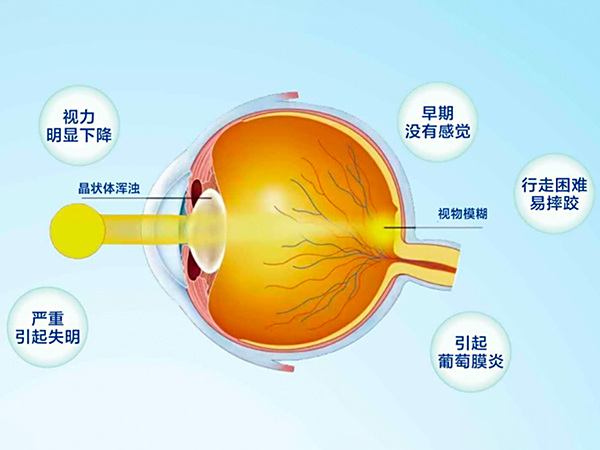 白内障