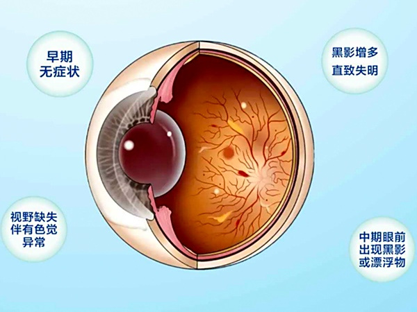 糖尿病视网膜病变