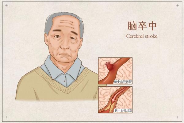 【世界卒中日】“卒”不及防，收好这份脑卒中康复攻略！