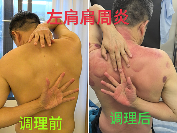 左肩肩周炎前后