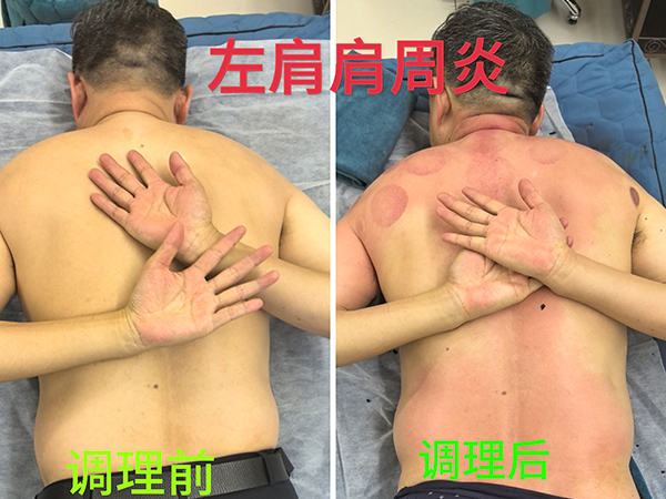 左肩肩周炎前后
