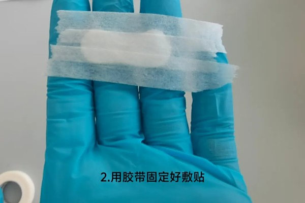 增生疤痕有救了？岳阳广济医院核素敷贴门诊：磷32敷贴，无创抑制增生，皮肤重归平整！
