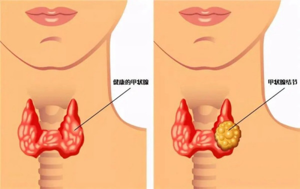 甲狀腺篩查免費(fèi)50名！301超聲診斷科專家親臨廣濟(jì)醫(yī)院義診！