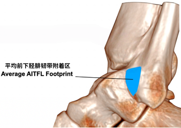 警惕！崴腳不是 “忍忍就好”，可能是腓骨撕脫性骨折，硬扛必吃虧！