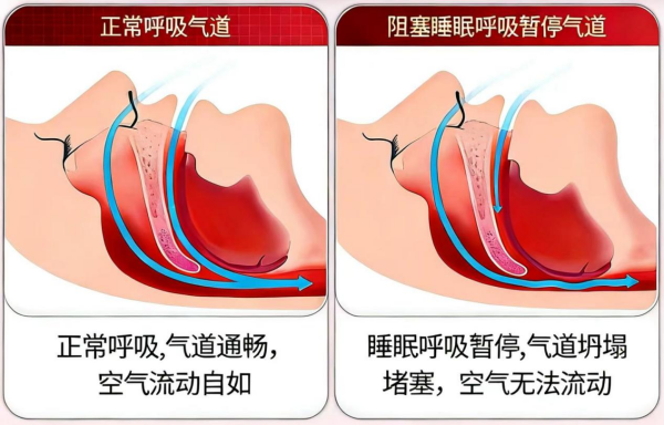 以為打鼾是睡得香？其實(shí)在傷心臟和血管