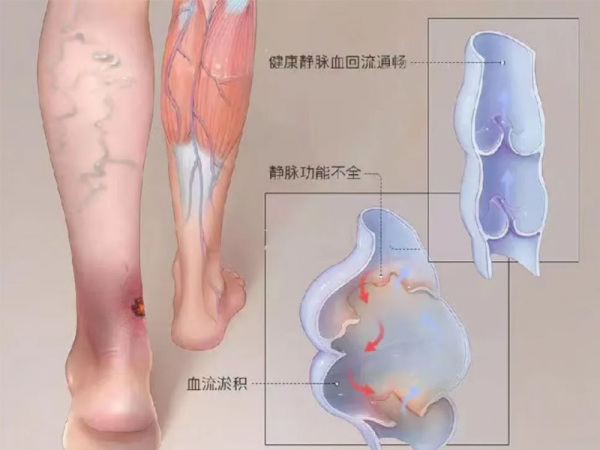 这些腿部异常信号别忽略，静脉曲张危害远超想象，岳阳广济金斗教授教你远离静脉曲张并发症！