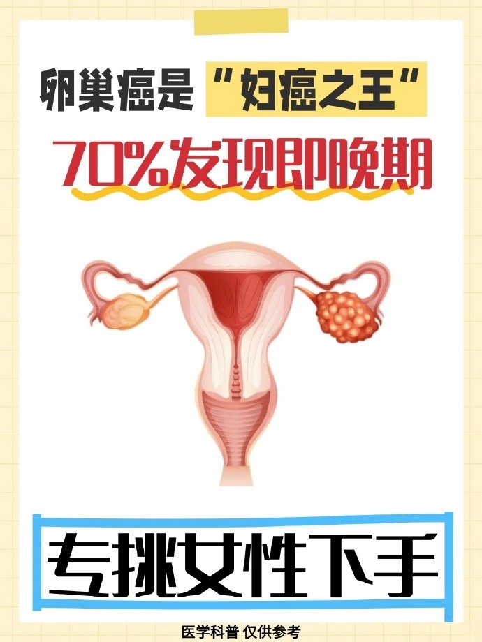 卵巢癌