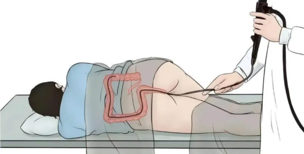 总腹泻以为只是吃坏肚子？警惕肠道癌变信号！