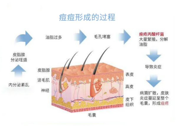 暑期战“痘”黄金期，这几点学生党必须知道
