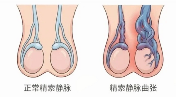 备孕久备不孕？警惕精索静脉曲张！藏在阴囊里的生育“隐形杀手”！